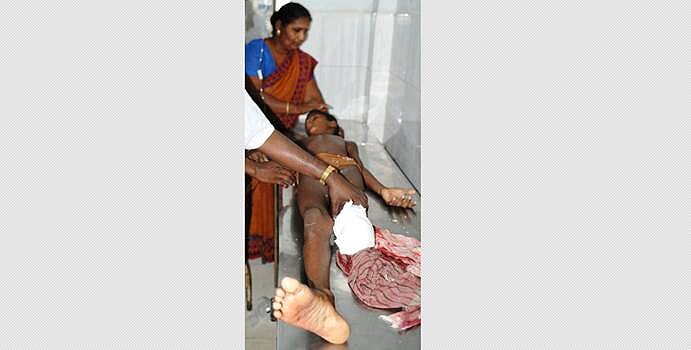 சிதம்பரம் அருகே முதலை கடித்து  இடதுகாலை இழந்த சிறுவன்